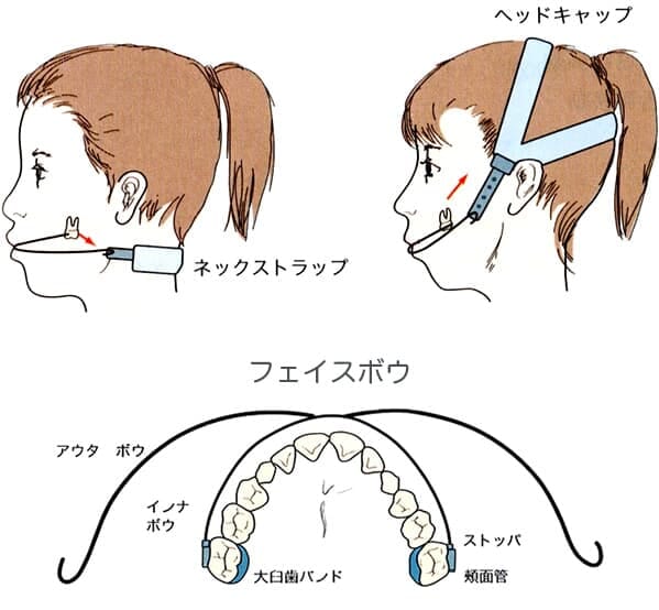 ヘッドギア