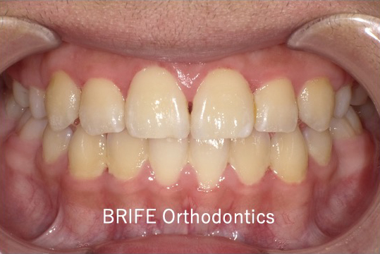 ブラックトライアングルって何 矯正治療のリスクの一つ ブラックトライアングルについて解説します ブライフ矯正歯科