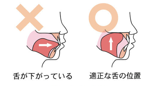 低位 舌 治っ た