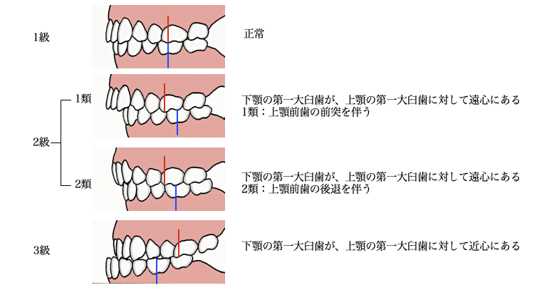 アングル の 不正 咬合